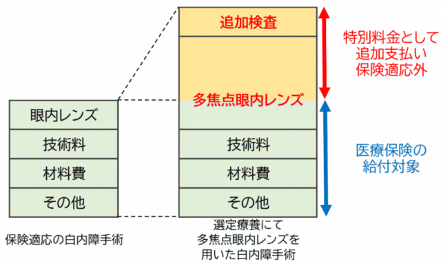 選定療養による白内障手術